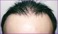 Before hair restoration